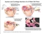 Picture of Suction and Curettage Abortion Diagram